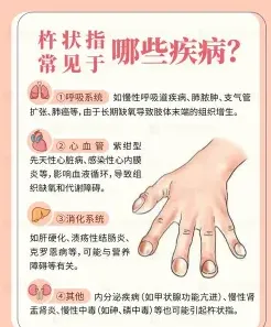 杵状指