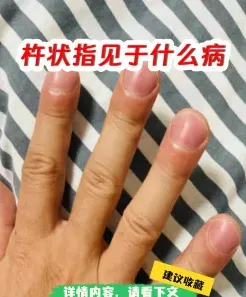 肺癌